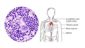 It is one of the most suggested methods for lymphoma treatment. Lymphoma Types Causes Symptoms Diagnosis Treatment