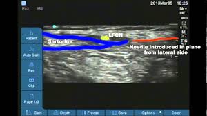 На нем я апнул глобала на своем первом ноуте в 30 ф. Ultrasound Guided Lateral Femoral Cutaneous Nerve Of Thigh Block Youtube