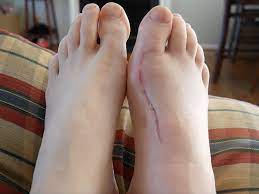Bunion Surgery Recovery | Week 8 | Walking & Driving Again! - Youtube