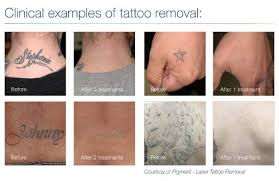 The crc tattoo remover system is even less invasive than tattoo vanish, so we typically recommend this method for clients with more delicate skin. Tattoo Removal In Panama City Sun Dermatology Panama City Florida