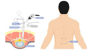 Minimally Invasive Spine Surgery - Dr ...