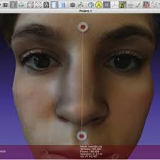 Accuracy (trueness and precision) of a dual-structured light facial scanner  and interexaminer reliability