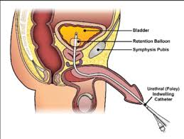 Indwelling Catheter Definition Types