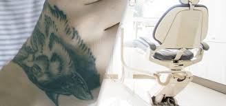 Does laser tattoo removal hurt? Optimizing Outcomes Of Laser Tattoo Removal