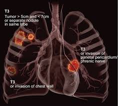 Lung cancer symptoms in dogs. Role Of Fdg Pet Ct In The Eighth Edition Of Tnm Staging Of Non Small Cell Lung Cancer Radiographics