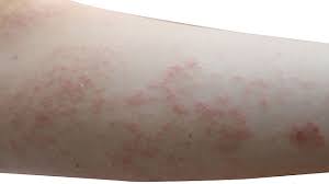 A csalánkiütés (urticaria) igen kellemetlen bőrbántalom, nemtől és kortól függetlenül bárkinél jelentkezhet. Csalankiutes Parazitak Miatt Fergek A Hasnyalmirigy Tuneteiben