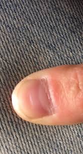 Rillen Im Fingernagel Fingernagel