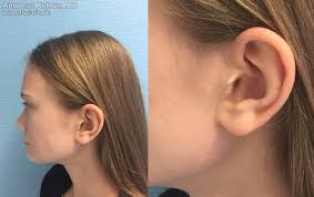 Piercing rejection happens when the immune system sees the jewelry as a foreign object and tries to push it back choosing a qualified and experienced piercer. Inconspicuous Scars Fazialis