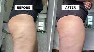 I Tried Avéli Cellulite Treatment — With Before and Afters | Allure
