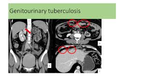 Image result for Genitourinary Tuberculosis