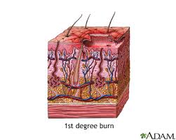Maybe you would like to learn more about one of these? First Degree Burn Medlineplus Medical Encyclopedia Image