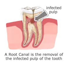 Image result for root canal