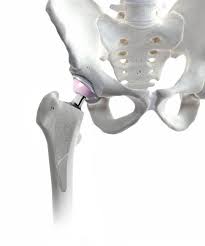Der leidensdruck des patienten bestimmt dabei, wann eine operative therapie und ggf. Minimalinvasive Operation Der Huftprothese Gelenk Klinik De