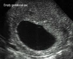 A blighted ovum usually occurs between the 8th and 13th weeks of pregnancy. Experiencing Miscarriage Wehavekids