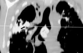 Image result for Broncholithiasis