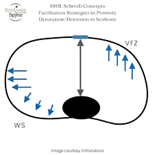 أنواع تمارين اعوجاج العمود الفقري الأكثر شيوعًا