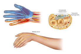 Carpal Tunnel Syndrome
