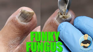have nail fungus you need to be doing