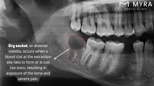 Image result for Dry Socket