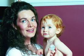 Scott Maciver Boy Worlds Smallest Pacemaker Editorial Stock Photo