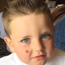 my son had that spot for 3 years , it was rare tumour he is fit and healthy  now , but would love a picture without the spot thanks in advance xx