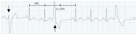 But you might feel an odd sensation in your chest, such as Premature Ventricular Complex Pvc Litfl Ecg Library Diagnosis