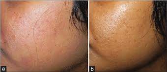 Retinoic Acid And Glycolic Acid Combination In The Treatment Of Acne Scars Chandrashekar B S Ashwini K R Vasanth V Navale S Indian Dermatol Online J