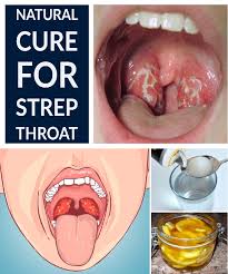 8 Effective Natural Home Remedies To Treat A Strep Throat Infection In 2020 Strep Throat Remedies Strep Throat Natural Home Remedies