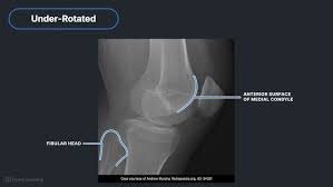 Image result for Knee XRay