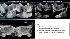 Image result for Chronic Bacterial Prostatitis