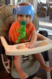 Baby Helmets For Flat Head Syndrome Options Cost And Insurance