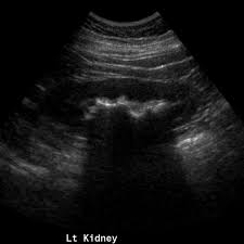 Read about passing of the kidney stones in urine. Staghorn Calculus Radiology Case Radiopaedia Org Medical Ultrasound Diagnostic Imaging Diagnostic Medical Sonography