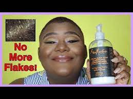 Get Rid Of That Crusty Scalp Girl Seborrheic Dermatitis Dandruff And Dry Scalp On 4c Hair Youtube Dry Scalp Seborrheic Dermatitis Scalp Dermatitis