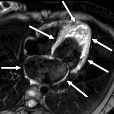Image result for Cardiac MRI