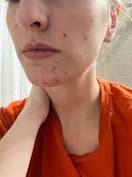 Alternative skin care for puffy face after being glutened