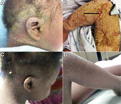 Image result for scabies norvegica