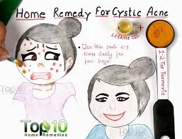 Home Remedies For Cystic Acne Top 10 Home Remedies Cystic Acne Remedies Cystic Acne Home Remedies For Acne