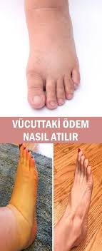 Vucuttaki Odem Nasil Atilir Saglik Vucut Takilari Diyet