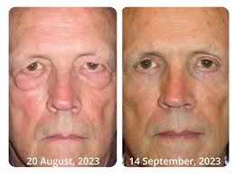 Flysmus™ WhiteSpots Threapy Bee Venom Eye Cream