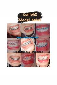 Apr 30, 2020 · warna karet behel yang bagus untuk perempuan, roda warna untuk behel, warna behel hitam, warna behel yang lagi trend, warna karet behel silver, warna karet behel yang lagi trend 2020, warna karet behel putih, warna karet behel hijau tosca, inspirasi 31+ warna karet behel keramik yang bagus. Nisa Behel Kasemen Posts Facebook