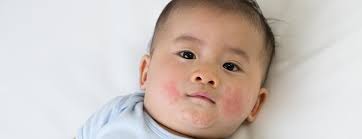 Image result for Impetigo