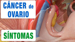 Toda la información sobre síntomas, causas, tratamientos. Todos Los Sintomas Del Cancer De Ovario Youtube