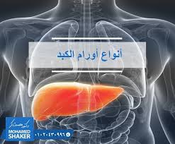 هل جميع الاورام التي تصيب الكبد اورام خبيثة الاجابة هي لا و ي عتبر ورم الكبد نمو ا غير طبيعي لخلايا الكبد ولأورام الكبد أنواع عديدة تختلف باختلا shaker