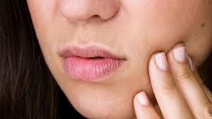 Most canker sores are round or oval with a white or yellow center and a red border. How To Get Rid Of Canker Sores Self