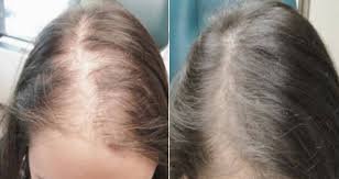 Normal hair thinning (resulting from follicular miniaturization) involving the temples, frontal hairline, and crown of the scalp, known as pattern alopecia, occurs in almost everyone as. Revifol Reviews Obvious Scam Or Real Hair Loss Support Courier Herald