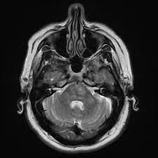 Chronic lymphocytic inflammation with pontine perivascular enhancement responsive to steroids (clippers) is a rare central nervous system inflammatory disease characterized by the punctate gadolinium enhancement peppering the pons and the cerebellar peduncles as neuroimaging. Chronic Lymphocytic Inflammation With Pontine Perivascular Enhancement Responsive To Steroids Clippers Radiology Case Radiopaedia Org