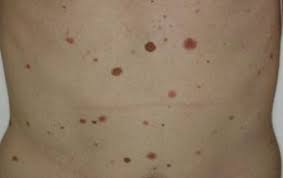 Un grain de beauté qui saigne ou qui gratte ne constitue pas forcément une urgence médicale ! Grain De Beaute Et Naevus Nevus Dr Abimelec