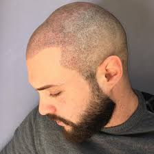 La micro pigmentazione, conosciuta anche come trucco permanente o semipermanente, è una specialità estetica che prevede l'introduzione nella cute, per mezzo di . Contro La Calvizie Tricopigmentazione Dermostudiolab Genova