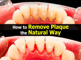Acetic acid in white vinegar promotes the demineralization of tooth. Pin On Natural Remedies