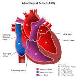 Image result for icd 10 code for atrial septal defect repair